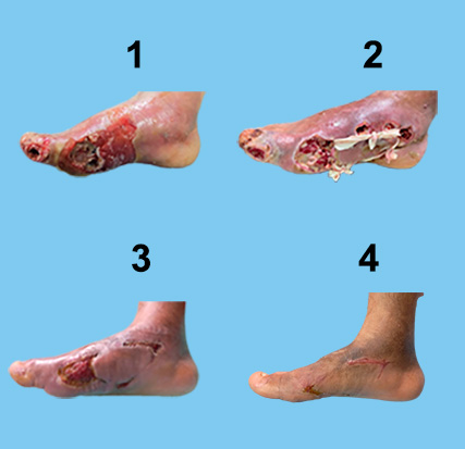 Pie Diabético Avance de la cura